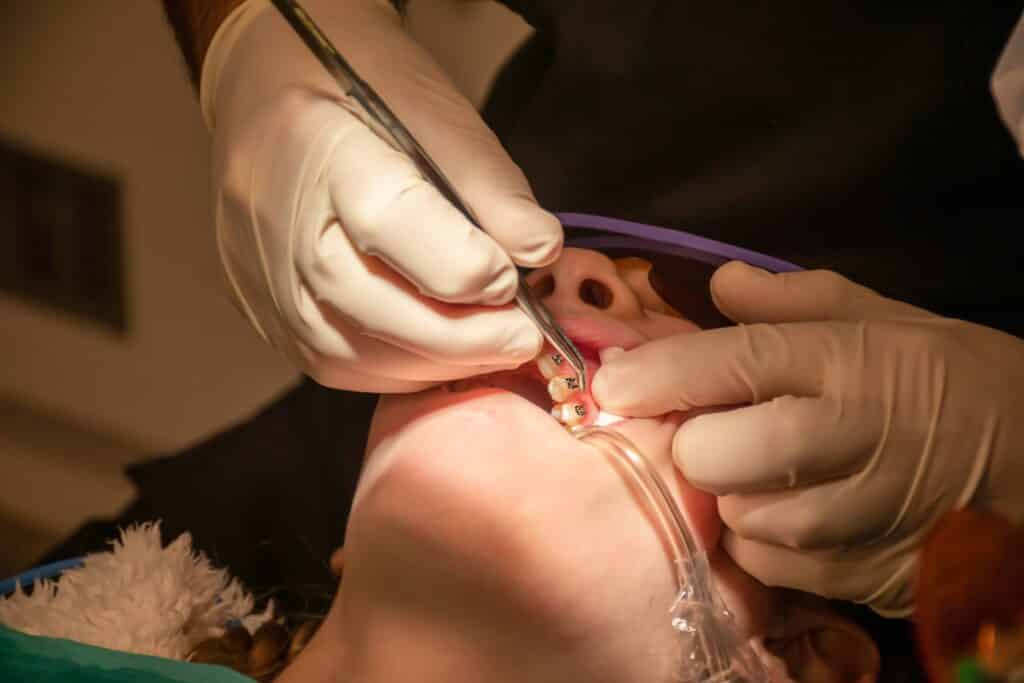 Повреждение лицевого нерва и имплантация зубов